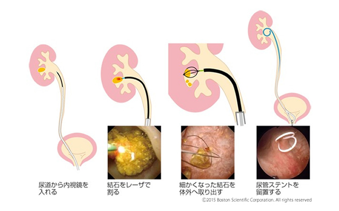 経尿道的尿路結石除去術（TUL）